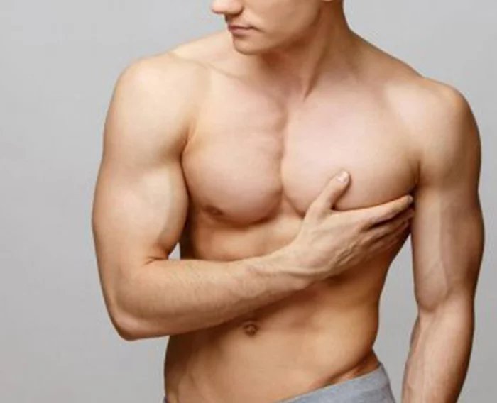 gynecomastia