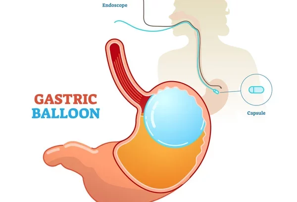 elipse swallowable gastric balloon in turkey