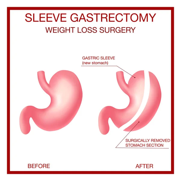 does a gastric sleeve shorten your life